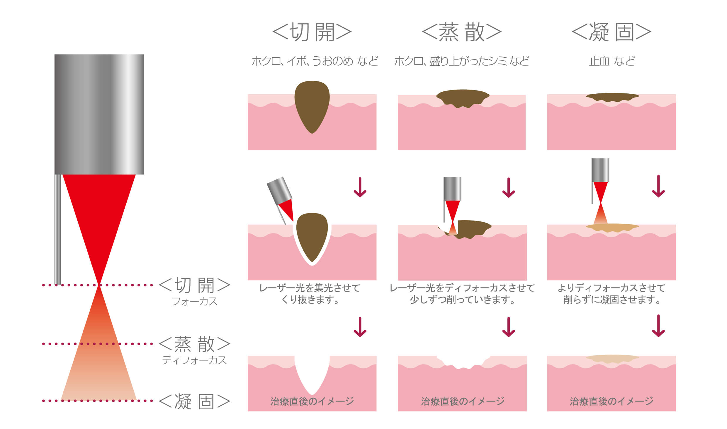 炭酸ガスレーザーエスプリ治療のメカニズム