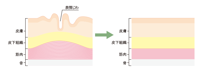 ボトックス注射イメージ