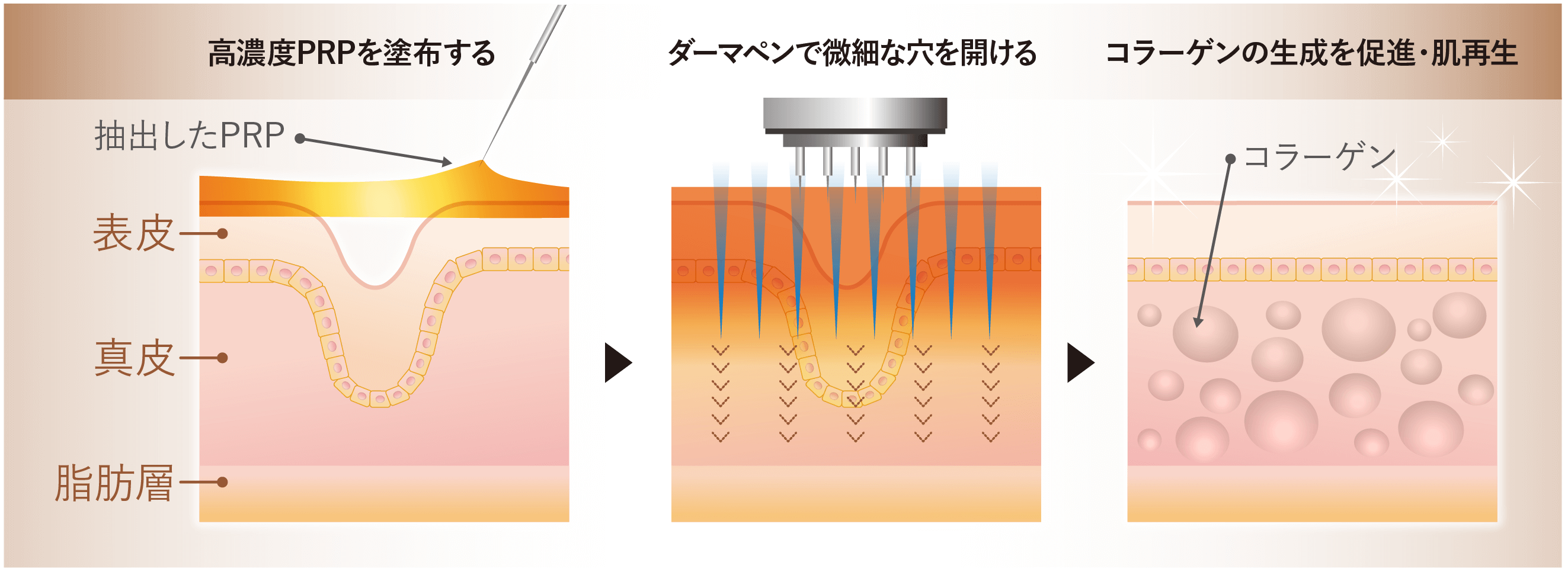 ヴァンパイアフェイシャル図解