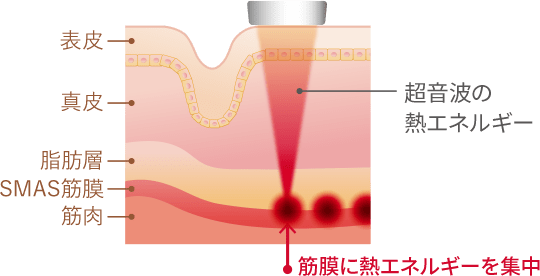 ハイフ治療イメージ