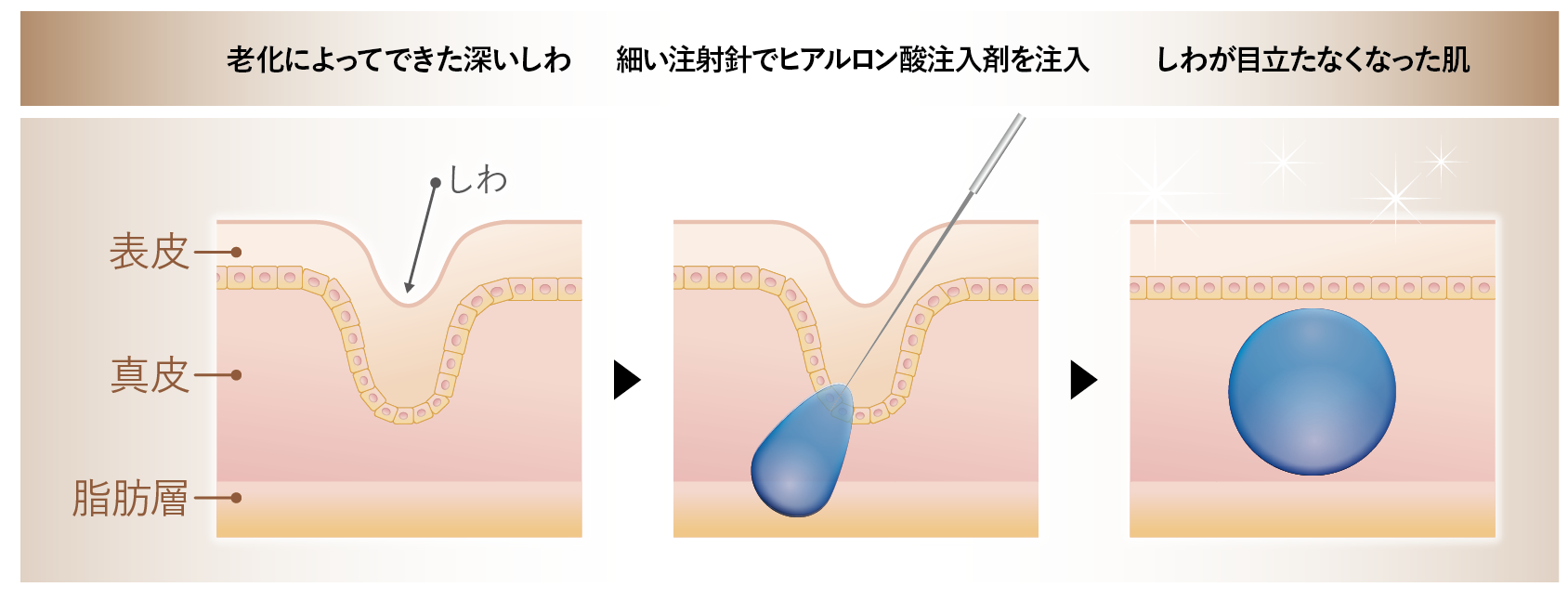 ヒアルロン酸注射イメージ